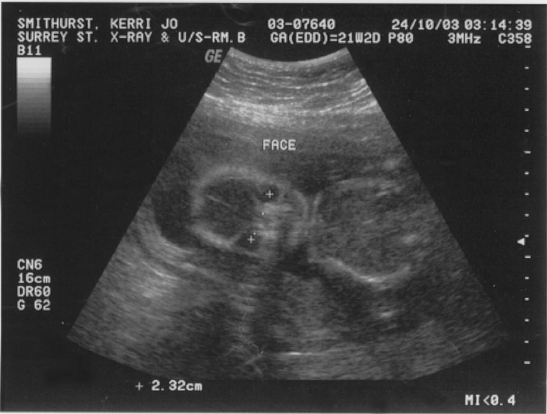 22 weeks – Baby or Alien